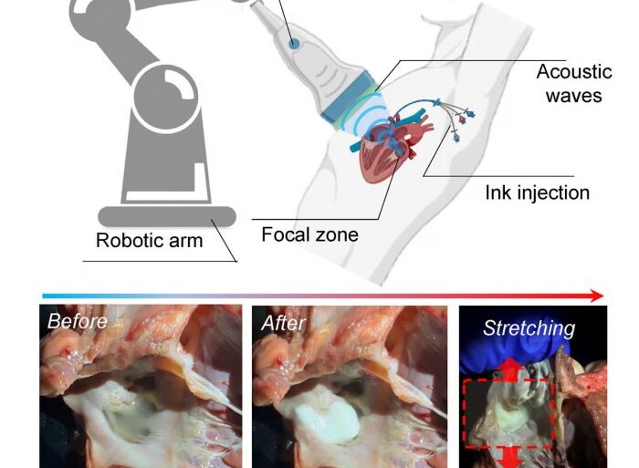 Sound waves could 3d print implants inside your body