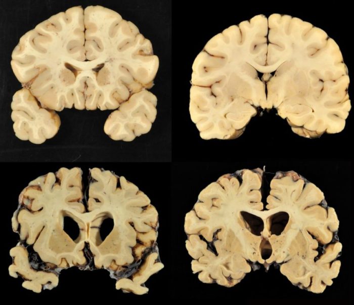 Encephalopathy chronic traumatic cte disease brain phases killer siowfa16 figures goes below through can see Encephalopathy chronic traumatic cte disease brain phases killer siowfa16 figures goes below through can see